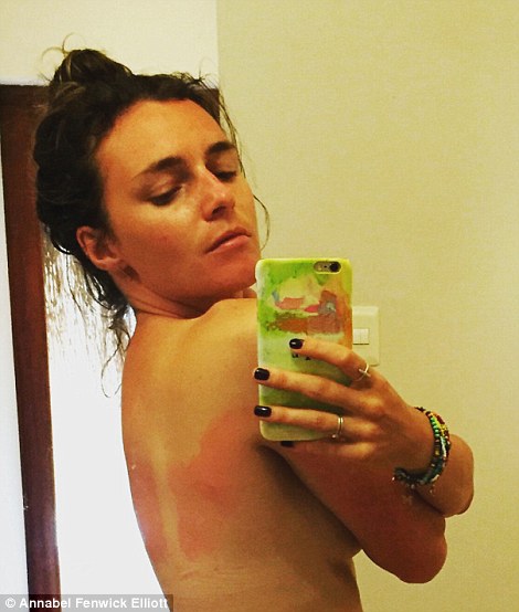Annabel was sunburnt on the bit of her back that she couldn't reach
