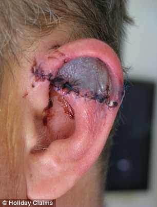 Luszczewski claims he was struck in the face and head by components of the bus, which caused his ear to be severed in half